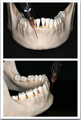 <p>what nerve is anesthetized with SUPRAPERIOSTEAL INJECTION?</p>