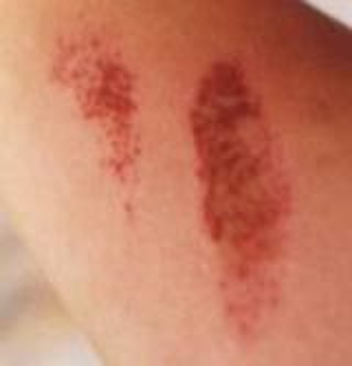 <p>scraping way of skin or mucous membranes</p>