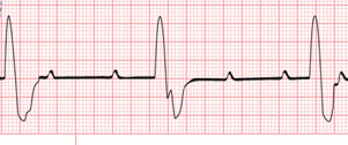 <p>P-wave:</p><p>Normal</p><p>PR Interval: &gt;.20 (prolonged)</p><p>QRS: &lt;0.12</p><p>Rate: 60-100</p><p>Regularity: Regular</p>