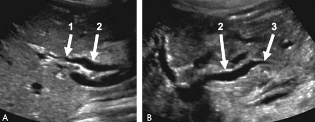 <p>When sweeping through the liver, if you see dilated structures, investigate the surrounding organs and make sure to <span style="color: yellow;">confirm whether it’s a duct or a vessel</span> (color, turn on it)</p><p>Why are we seeing these?</p>