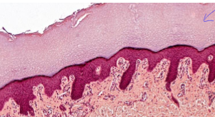 <p>stratified squamos epthitelial, keratinized</p>
