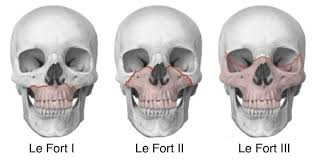 <p>Gãy Lefort 2 đi xuyên qua cấu trúc trợ lực nào của tầng mặt giữa ?</p><p>A. Bờ dưới ổ mắt</p><p>B. Mòm huyệt răng xương hàm trên</p><p>C. Bờ trên ổ mắt</p><p>D. Mỏm khẩu cái xương hàm trên </p>