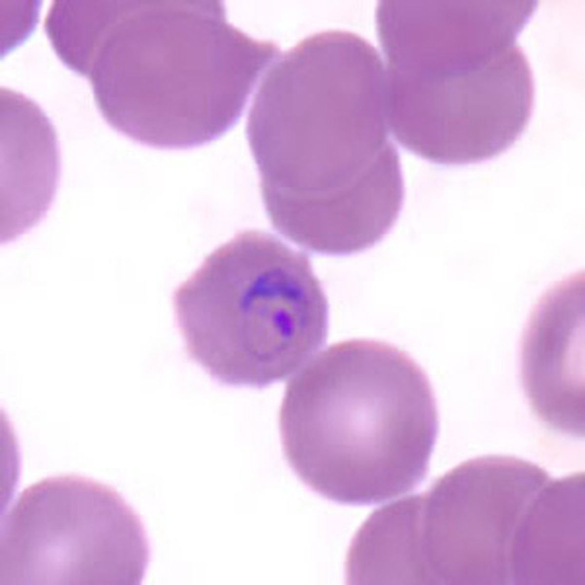 <p>• Infects senescent RBCs (small to</p><p>normal)</p><p>• Ring form 1/3 size of RBC, thick</p><p>o Bird's eye</p><p>• Mature trophs = band and basket</p><p>forms</p><p>o Do not fill RBC</p><p>o Prominent pigment</p><p>• Schizont has 6-12 merozoites</p><p>o Rosette forms</p><p>• Gametocyte can fill RBC</p>
