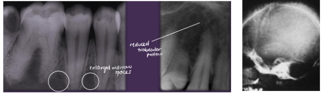 <p><span style="background-color: transparent; font-family: "Times New Roman", serif;"><u>SYSTEMIC</u>:</span></p><p><span style="background-color: transparent; font-family: "Times New Roman", serif;">*Chronic hemolytic anemia</span></p><p><span style="background-color: transparent; font-family: "Times New Roman", serif;">*Ischemia, infarction, ulcers of distal extremities</span></p><p><span style="background-color: transparent; font-family: "Times New Roman", serif;">*Infections (due to destruction of spleen)</span></p><p><span style="background-color: transparent; font-family: "Times New Roman", serif;">*Impaired kidney function</span></p><p><span style="background-color: transparent; font-family: "Times New Roman", serif;">*Ocular damage</span></p><p><span style="background-color: transparent; font-family: "Times New Roman", serif;">*CNS damage/stroke</span></p><p><span style="background-color: transparent; font-family: "Times New Roman", serif;">*<strong>Sickle Cell Crisis</strong> = severe sickling of rbcs</span></p><p><span style="background-color: transparent; font-family: "Times New Roman", serif;"> - <strong>precipitated by hypoxia, infection, hypothermia, dehydration</strong></span></p><p><span style="background-color: transparent; font-family: "Times New Roman", serif;"> - extreme pain from ischemia and infarction of tissues</span></p><p><span style="background-color: transparent; font-family: "Times New Roman", serif;"> - mostly affect long bones, lungs, and abdomen</span></p><p><span style="background-color: transparent; font-family: "Times New Roman", serif;"> - pulmonary involvement = acute chest syndrome<br></span></p><p><span style="background-color: transparent; font-family: "Times New Roman", serif;"><u>ORAL</u>:</span></p><p><span style="background-color: transparent; font-family: "Times New Roman", serif;">*Reduced trabecular pattern</span></p><p><span style="background-color: transparent; font-family: "Times New Roman", serif;">*Enlarged marrow spaces</span></p><p><span style="background-color: transparent; font-family: "Times New Roman", serif;"><strong>*“Hair-on-end” on skull x-ray</strong></span></p><p><span style="background-color: transparent; font-family: "Times New Roman", serif;">*Increased prevalence of osteomyelitis</span></p><p><span style="background-color: transparent; font-family: "Times New Roman", serif;">*<strong>Spontaneous, asymptomatic pulpal necrosis</strong></span></p>