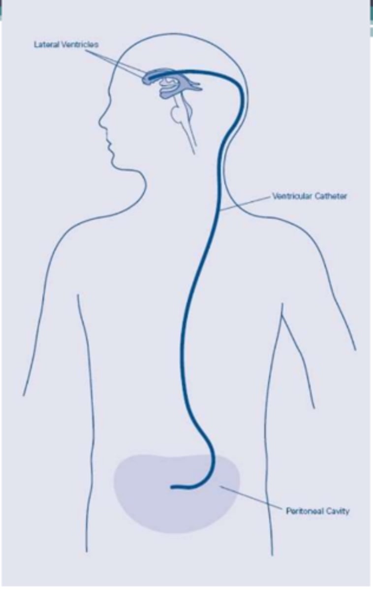 <p>Clinical Implications of VA &amp; VP Shunts:</p><p>- Patients undergo general anesthetic</p><p>- May be on bedrest for up to ________________________</p><p>- Avoid excessive _______________________ over the shunt, palpable under skin behind ear</p><p>- Incision areas: Scalp, neck, abdominal regions</p><p>- Monitor for signs of increased ICP: Confusion, lethargy, ______________________ paresis, HA, seizure, CN palsy, diplopia, _______________________ vision</p>