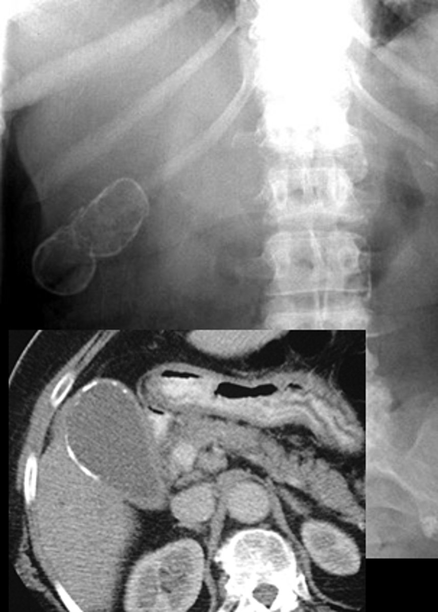 <p>Calcium salts</p><p>Gallbladder carcinoma</p><p>RESECTION</p>