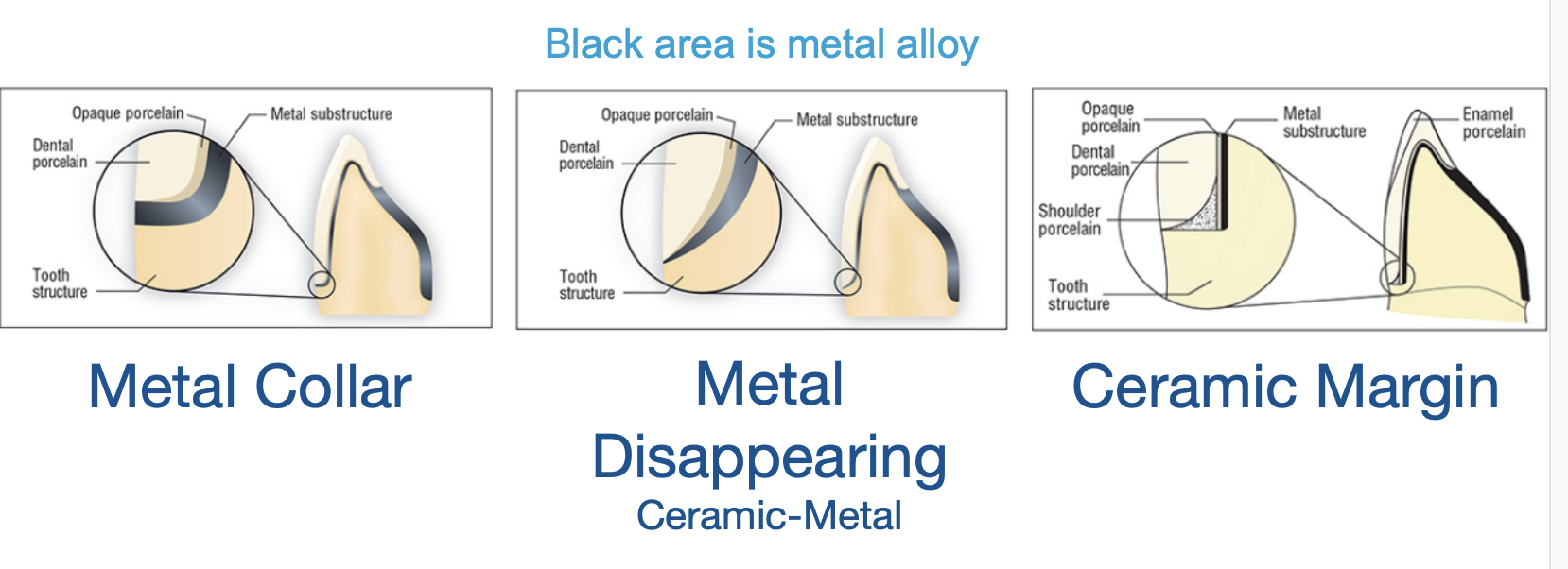 <ul><li><p>metal collar </p></li><li><p>metal disappearing </p></li><li><p>ceramic margin </p></li></ul><p></p>