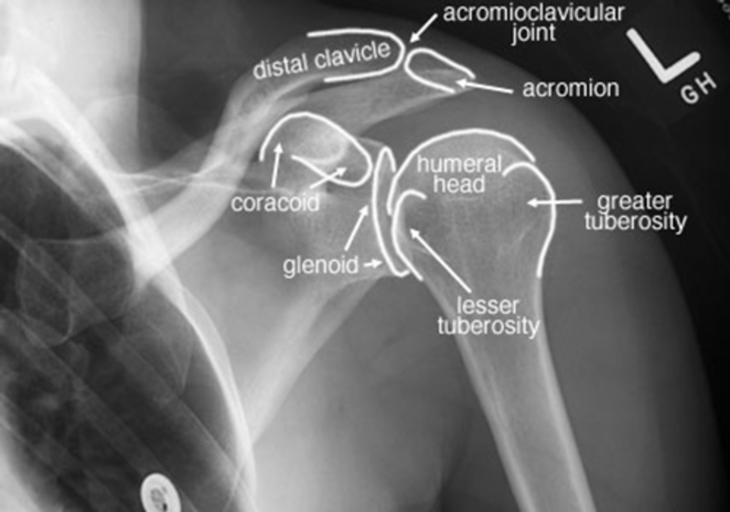 <p>Is this shoulder in EXTERNAL or INTERNAL rotation? Why?</p>