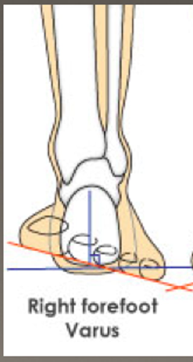<p>- inversion of forefoot</p><p>- subtalar joint in neutral</p>