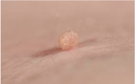 <p><span>How would you document this skin lesion?</span></p>