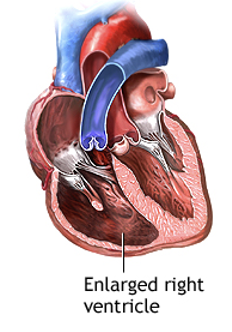 <p>What are the Secondary Causes of TR?</p>