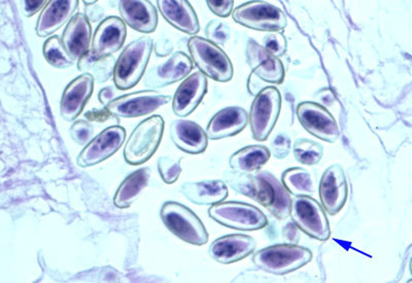 <p>The patient was a 55-year-old male immigrant from Korea. His current symptom was severe jaundice. He had had intermittent less severe bouts of jaundice in the past. During surgery, his proximal bile duct appeared to be enlarged with a nodular area of inflammation. A surgical biopsy was done and a parasite was observed in a stained tissue section residing in the lumen. Further examination revealed a collection of ova within the ovary of this fluke as see in this image (arrow). Which of the organisms listed below is most likely?</p>