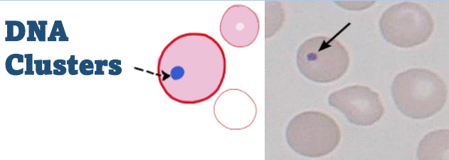 <p>Howell-Jolly bodies</p><p>The presence of Howell–Jolly bodies usually signifies a damaged or absent spleen, because a healthy spleen would normally filter such erythrocytes</p>