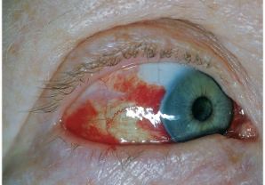 <p>Caused by coughing, vomiting, child birth. </p>