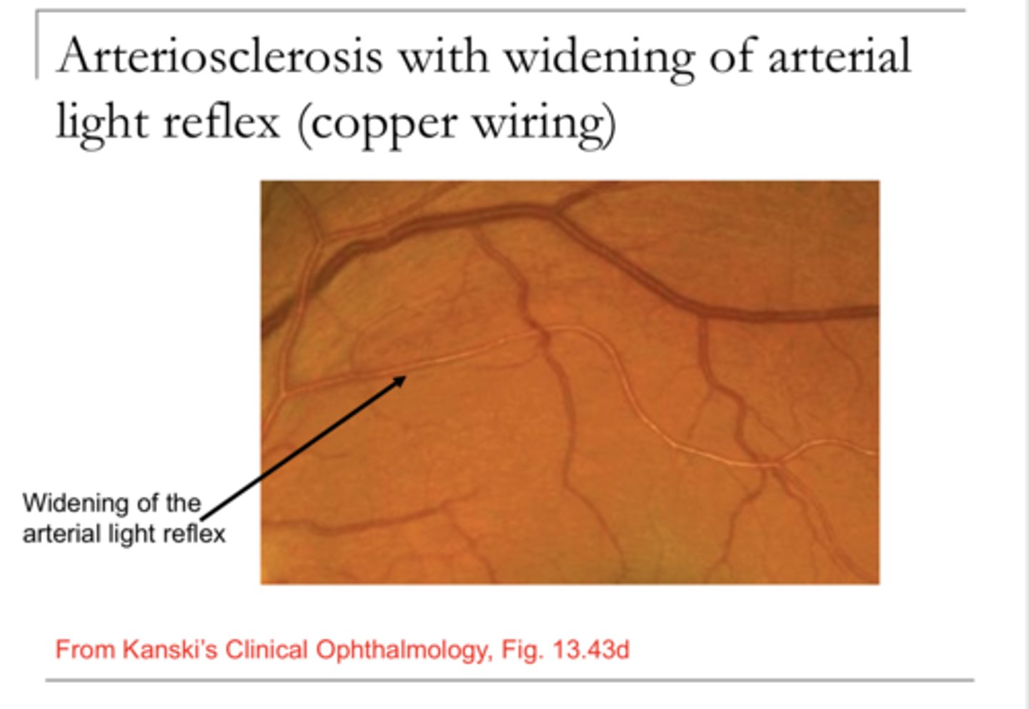 <p>Arteriosclerosis with Widening of Arterial Light Reflex - Copper Wiring (Pic)</p>