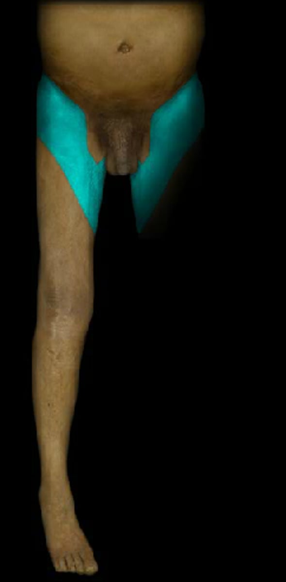 <p>Anterior proximal thigh</p>