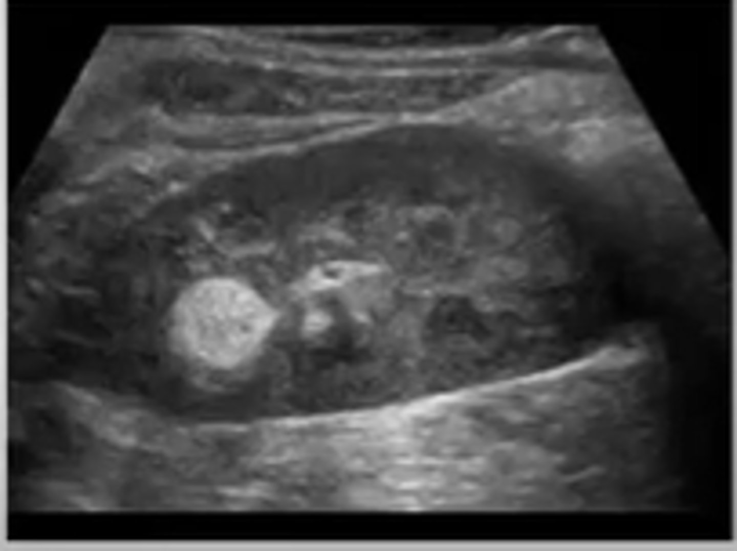 <p>What is the most common benign renal tumor? </p>
