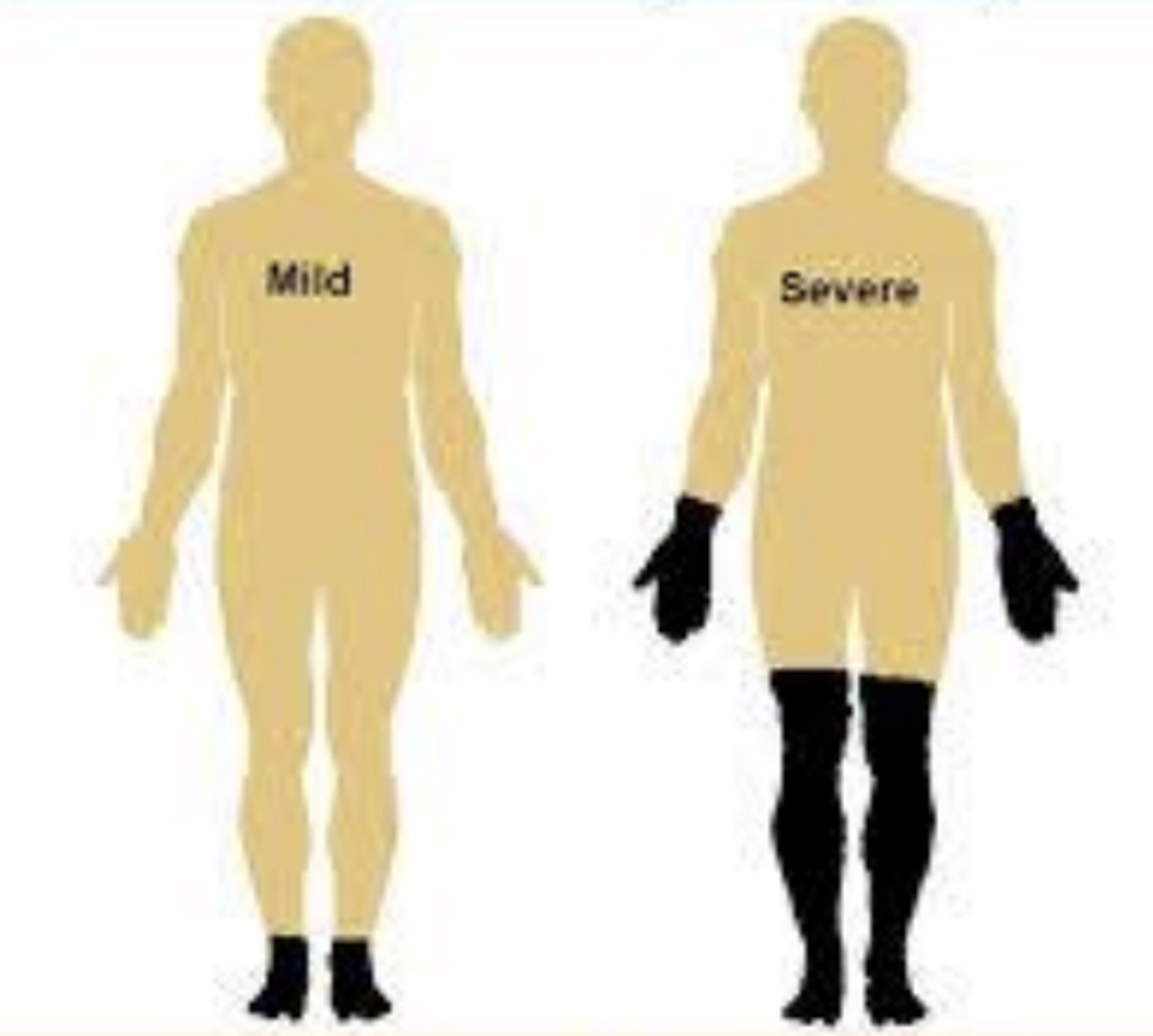 <p>Numbness, paresthesias, and pain, following a distal-to-proximal stocking-glove distribution.</p>