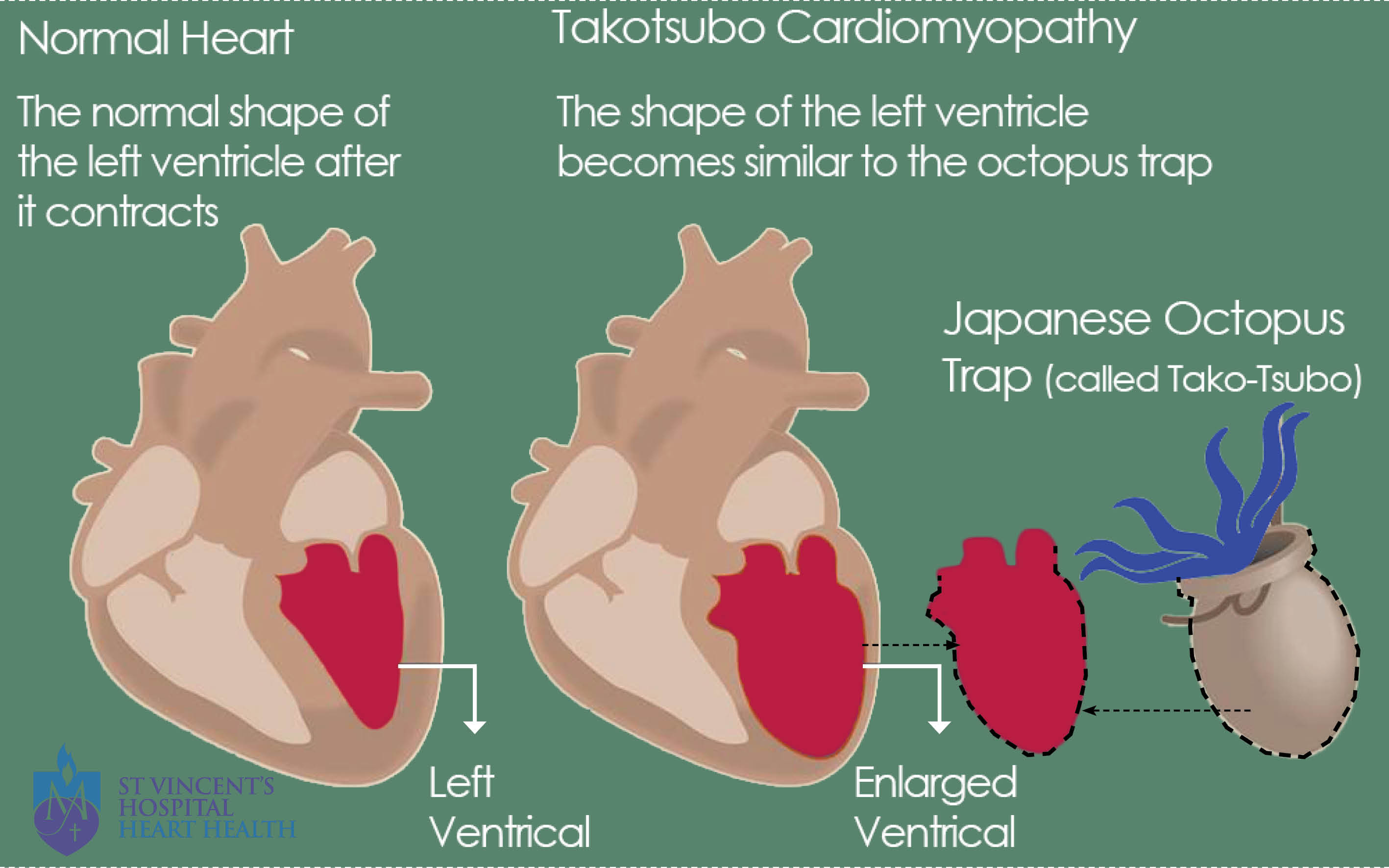 <p>Takotsubo Cardiomyopathy</p><ul><li><p> Also known as stress-induced cardiomyopathy, it mimics ACS but is typically precipitated by severe emotional or physical stress.</p></li></ul><p><strong>Takotsubo Cardiomyopathy</strong> is also known as stress-induced cardiomyopathy. It mimics ACS but is typically triggered by severe emotional or physical stress.</p>