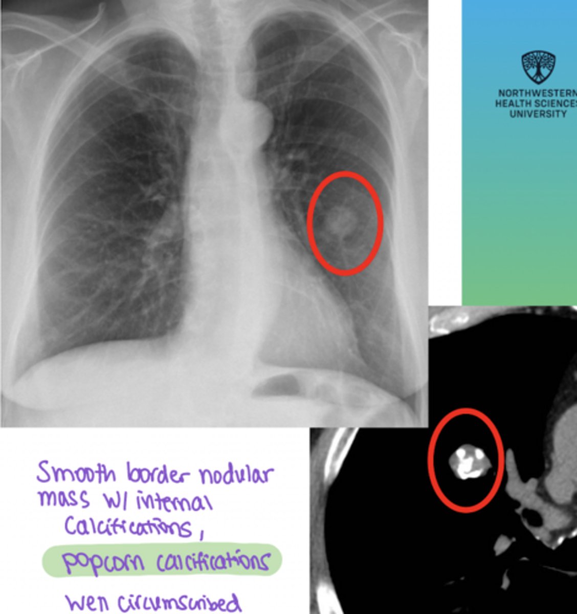 <p>A 45-year-old adult has an incidental finding on chest imaging of a peripherally located solitary pulmonary nodule. The lesion is asymptomatic and shows fat density with “popcorn” calcifications on CT.</p>
