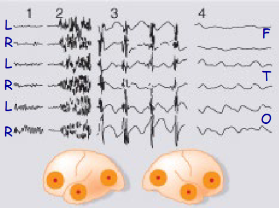 <p>1 – normal discharge, 2 – tonic phase, 3 – clonic phase, 4 – post-seizure coma</p>