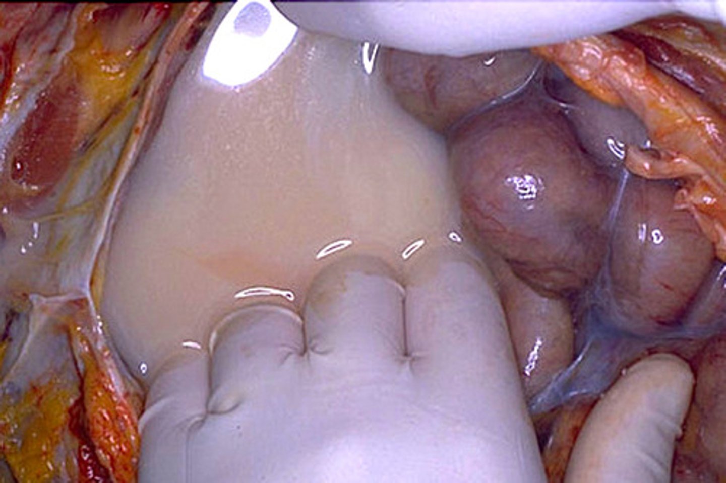 <p>white or pale yellow substance in lymph that contains fatty substances absorbed by the lacteals</p>