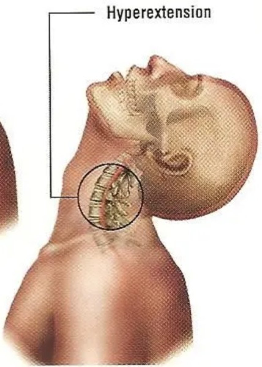 <p>Head violently moves forward and quickly hyperextends backwards</p>