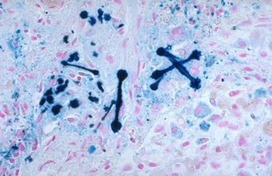 <p>¿Por qué se le denomina cuerpo ferruginoso?</p>