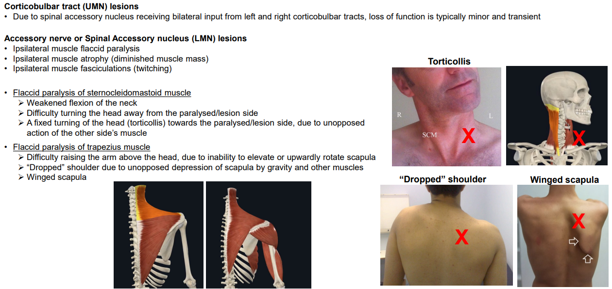 <ul><li><p>UMN lesion: Damage to a Corticobulbar Tract does not cause many issues, due to bilateral input from the other side</p></li><li><p>LMN lesion: Damage to the Accessory nerve or its nuclei can lead to ipsilateral LMN lesion symptoms</p><ul><li><p>Flaccid paralysis</p></li><li><p>Atrophy</p></li><li><p>Fasiculations</p></li><li><p>Only affecting SCM and Trapezius</p></li></ul></li><li><p>SCM damage: </p><ul><li><p>Poor flexion of the neck (head usually tilts contralaterally to damage)</p></li><li><p>Poor rotation away from lesion</p></li></ul></li><li><p>Trapezius damage: </p><ul><li><p>Difficulty raising arm above head due to poor scapular rotation</p></li><li><p>Ipsilateral dropped shoulder</p></li><li><p>Winged scapula</p></li></ul></li></ul><p></p>