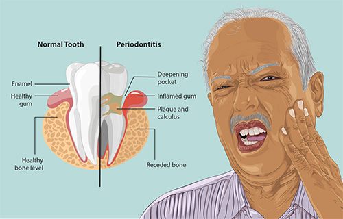 <p><span>Is inflammation of the supporting tissues of the teeth. This inflammatory process starts in the gingiva or gums and can spread to the alveolar bone supporting teeth.</span></p>