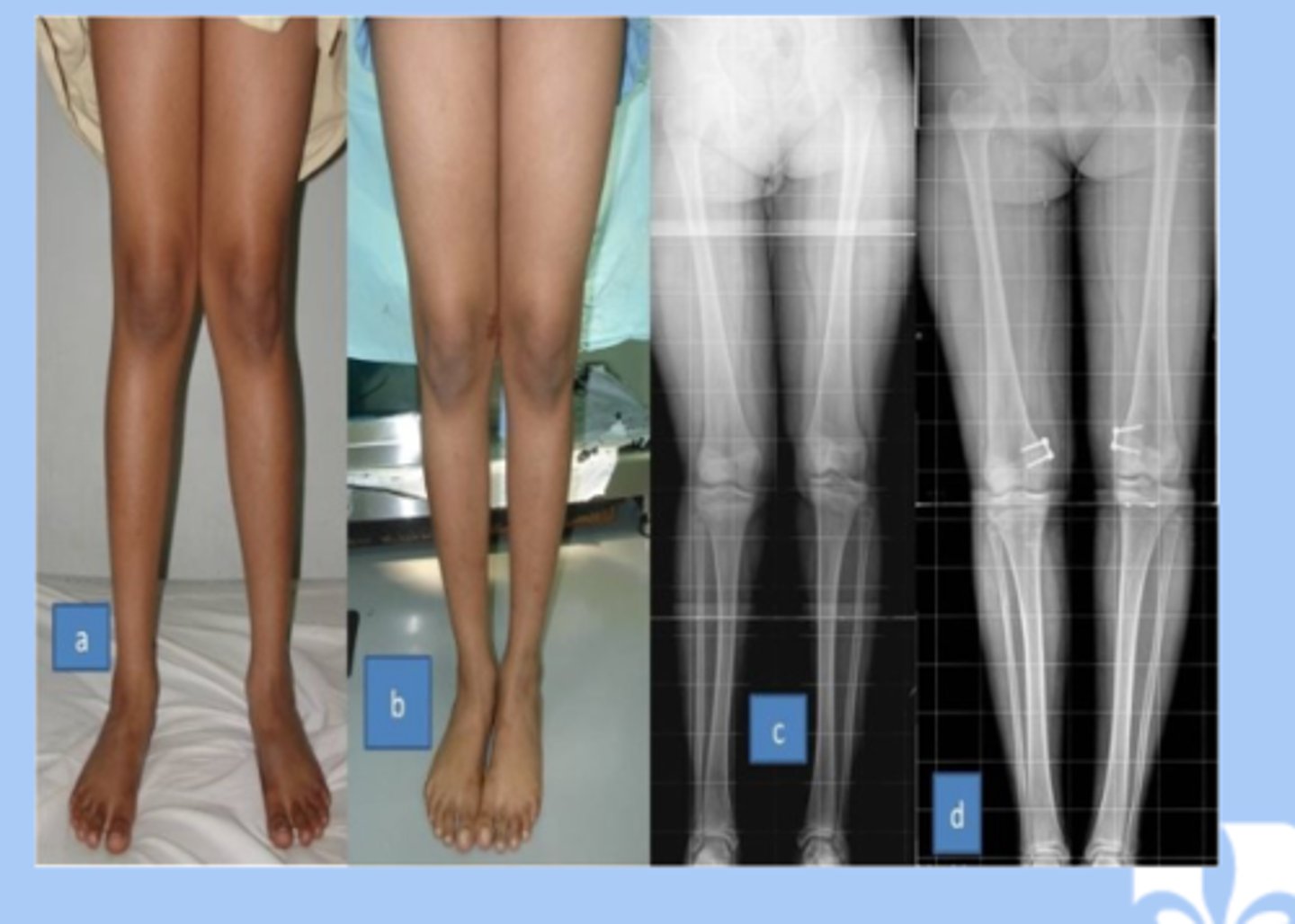 <p>-valgum: excessive valgus at the knee (knock kneed) </p><p>-3-8yr: valgum is normal</p><p>-pathologic: skeletal dysplasia or rickets, obesity </p><p>-referral in short stature, function limitations or pain, persist past normal timeline </p>