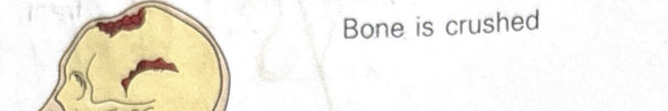 <p>fracture that crushes bone</p>