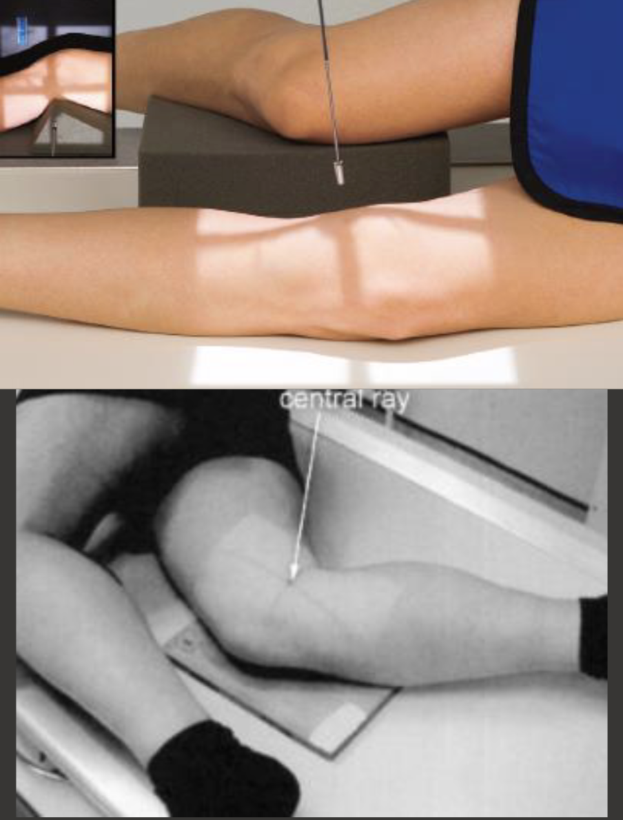 <p>Fine FS, 100cm</p><p>65kVp. 5mAs</p><p>Tube angle 5 degrees cephalic</p><p>CR: At level of posterior crease</p>