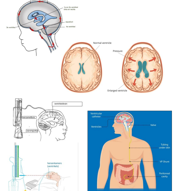 <p>Toename liquor in ventrikels → ventrikels groter → druk op hersenweefsel &amp; schedel</p><p>Ingrepen:</p><ul><li><p>ventriculo-externe drainage: via schedel</p></li><li><p>ventriculo-interne drainage: via buikholte </p></li></ul><p></p>