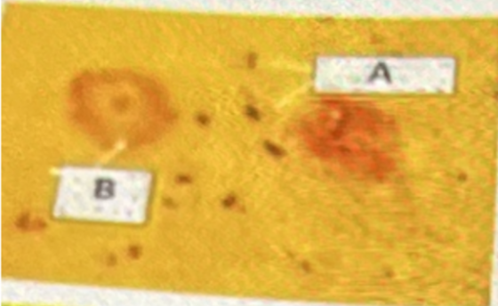 <p>The abnormal protein associated with A in the photo____</p><p>A- synuclein</p><p>B- amyloid </p><p>C- myelin </p><p>D- Tau </p><p>E E- Actin</p>