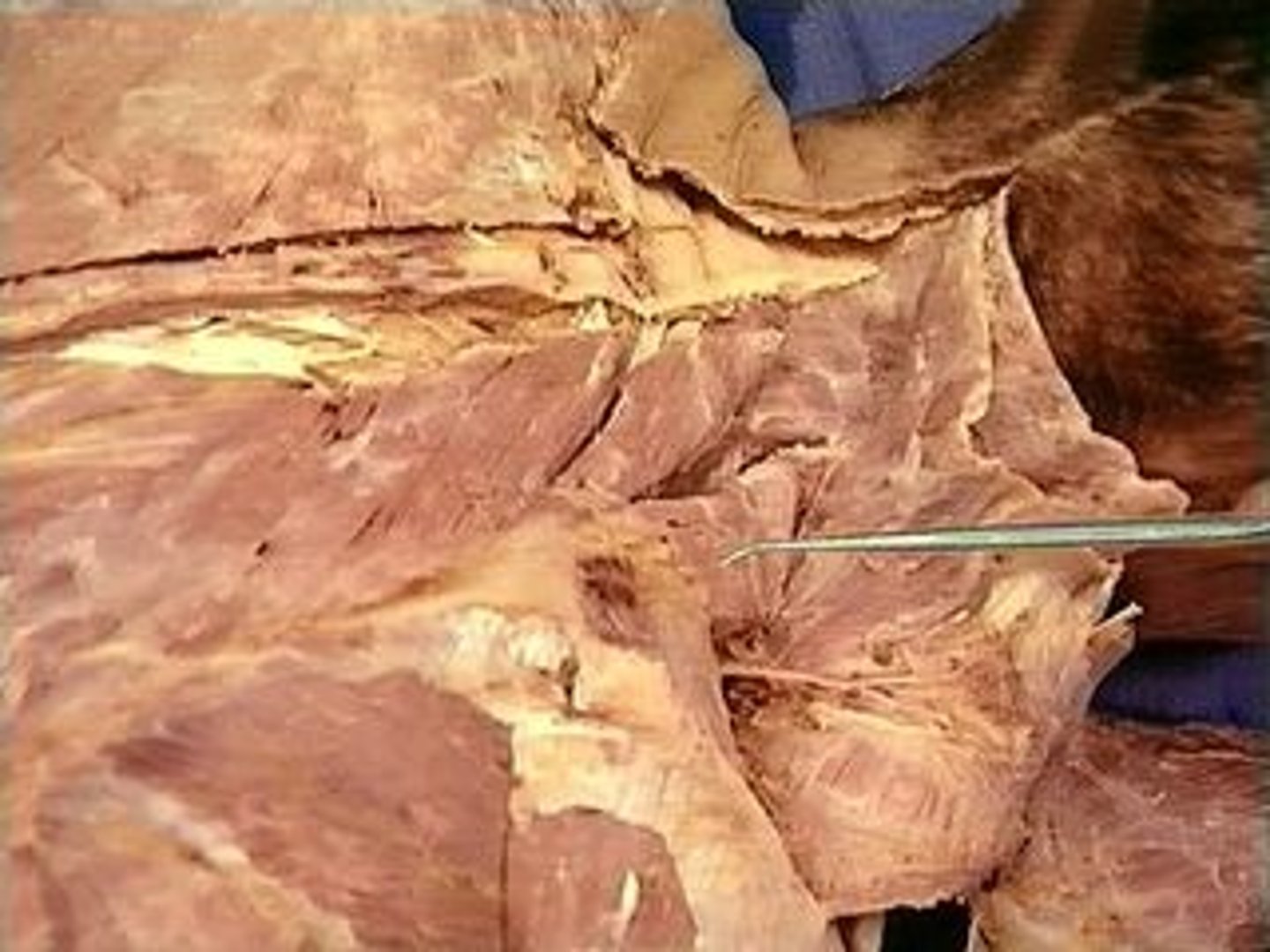 <p>Actions - elevation of the scapula &amp; downward rotation of the scapula , Between clavicle and the 2nd rib against sternum, back of the neck</p>
