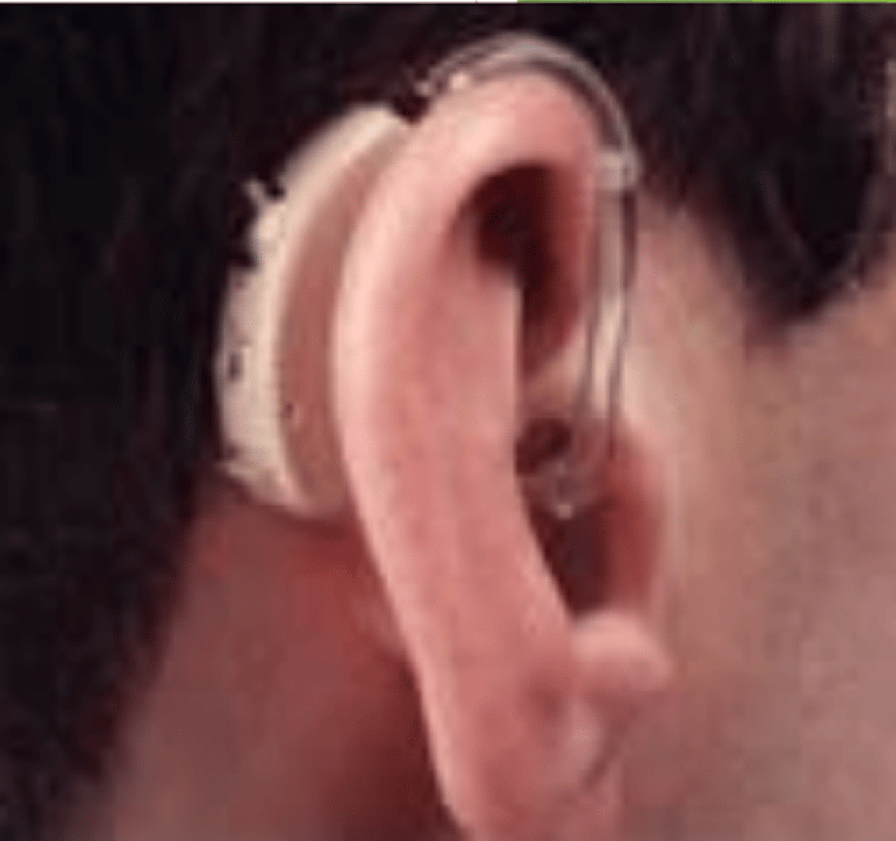 <p>a hearing aid worn behind the ear that captures sound through microphones, amplifies and processes it digitally, and delivers sound into the ear canal via tubing and an earmold</p>