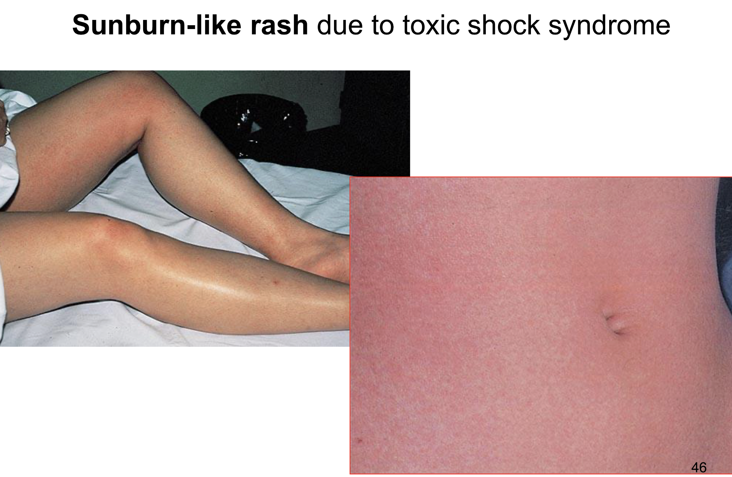 <p><strong>• Characterised by fulminant onset, high fever, erythematous rash with subsequent desquamation, hypotension and multi-organ damage.</strong></p><img src="https://knowt-user-attachments.s3.amazonaws.com/c7a8e72b-7670-491d-b0f0-866c2e24dfb7.png" data-width="25%" data-align="center"><p><em>• Now, </em><strong><u>non-menstrual cases </u>associated with localised infections and surgery.</strong></p><p><strong>• Mortality 3 to 6%.</strong></p>