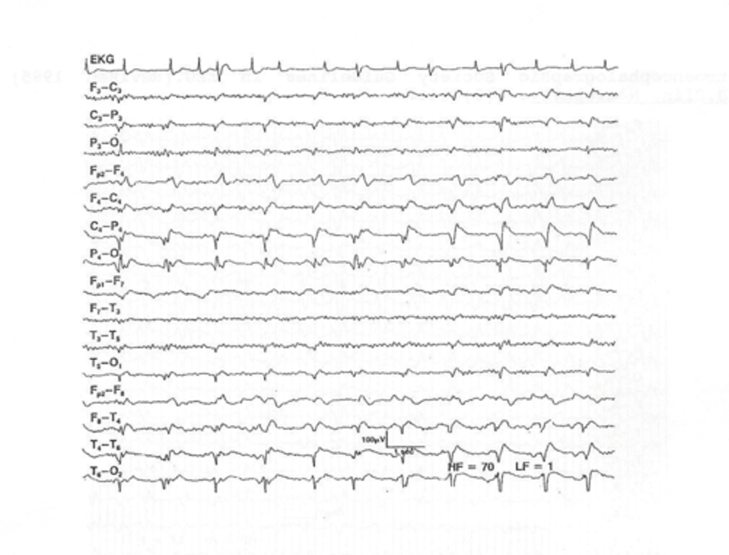 <p>In Viral Encephalitis, the EEG shows what?</p>