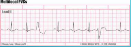 
Abnormal Contraction starting from ectopic focus (ventricles)