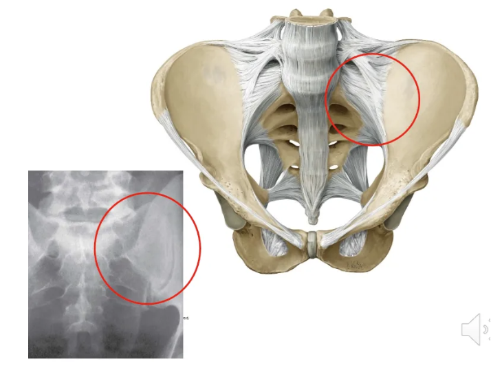 <p>A fibrous and synovial joint with limited mobility.</p><ul><li><p>Connects the sacrum to the ilium.</p></li></ul><p></p>