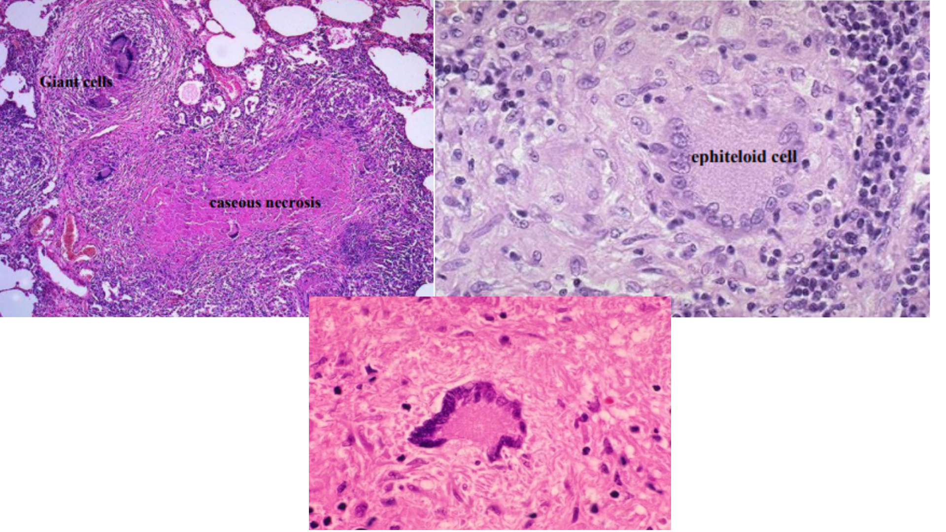 <p>Pulmonary Tuberculosis</p>