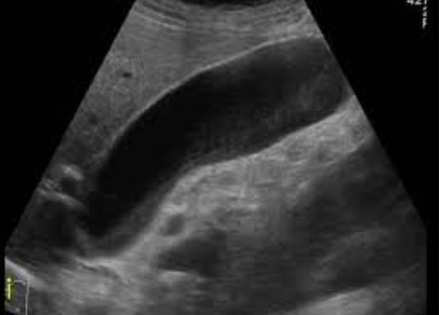 <p>Enlarged painless GB due to distal biliary obstruction (usually pancreatic tumor) </p><p>Large distended GB; no stones; pancreatic head mass; dilated ducts </p>