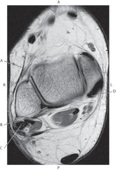 <p><span style="color: purple">Which line is pointing to the posterior talofibular ligament?</span></p>