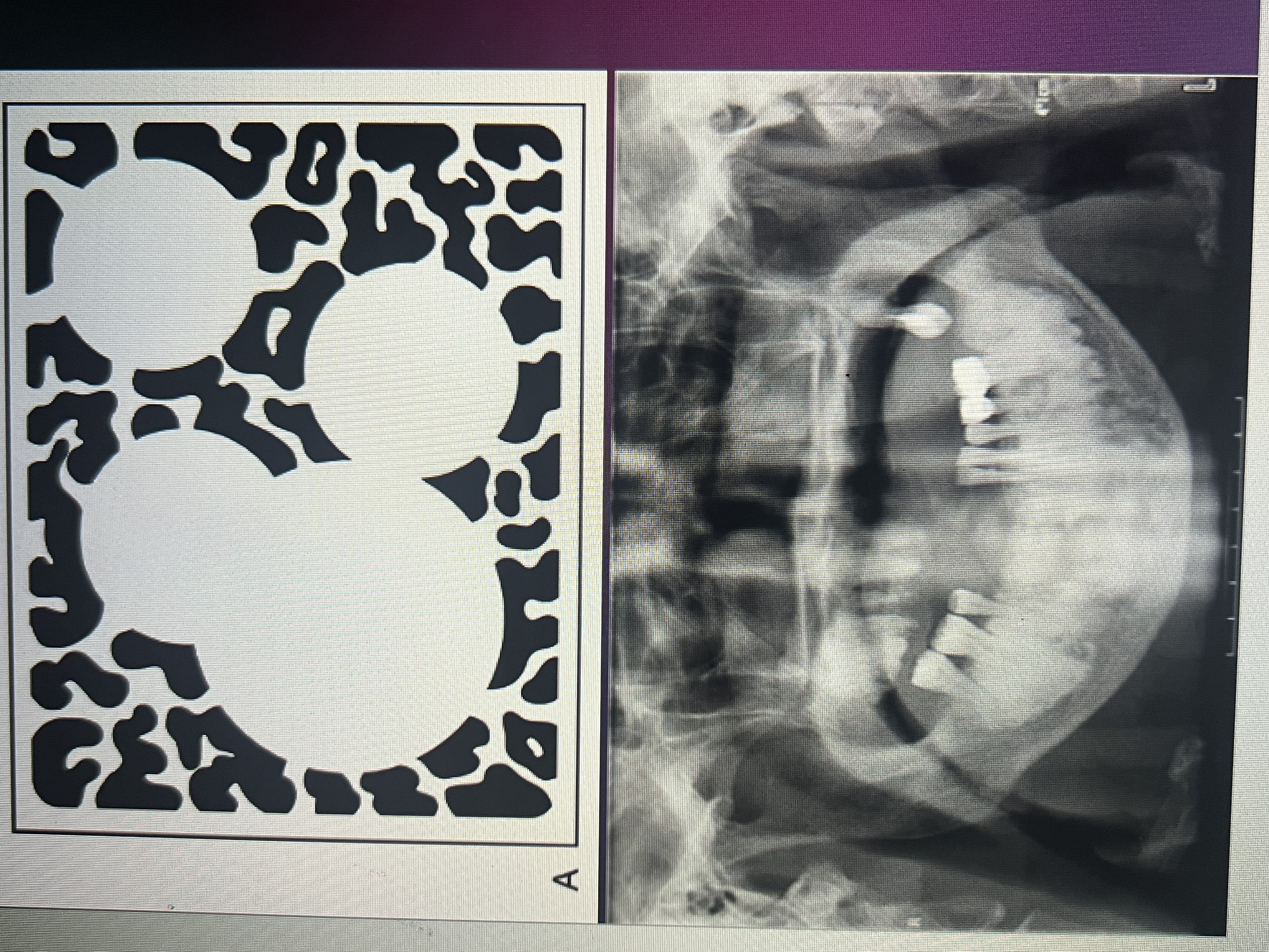 <p>Multifocal confluent pattern</p>