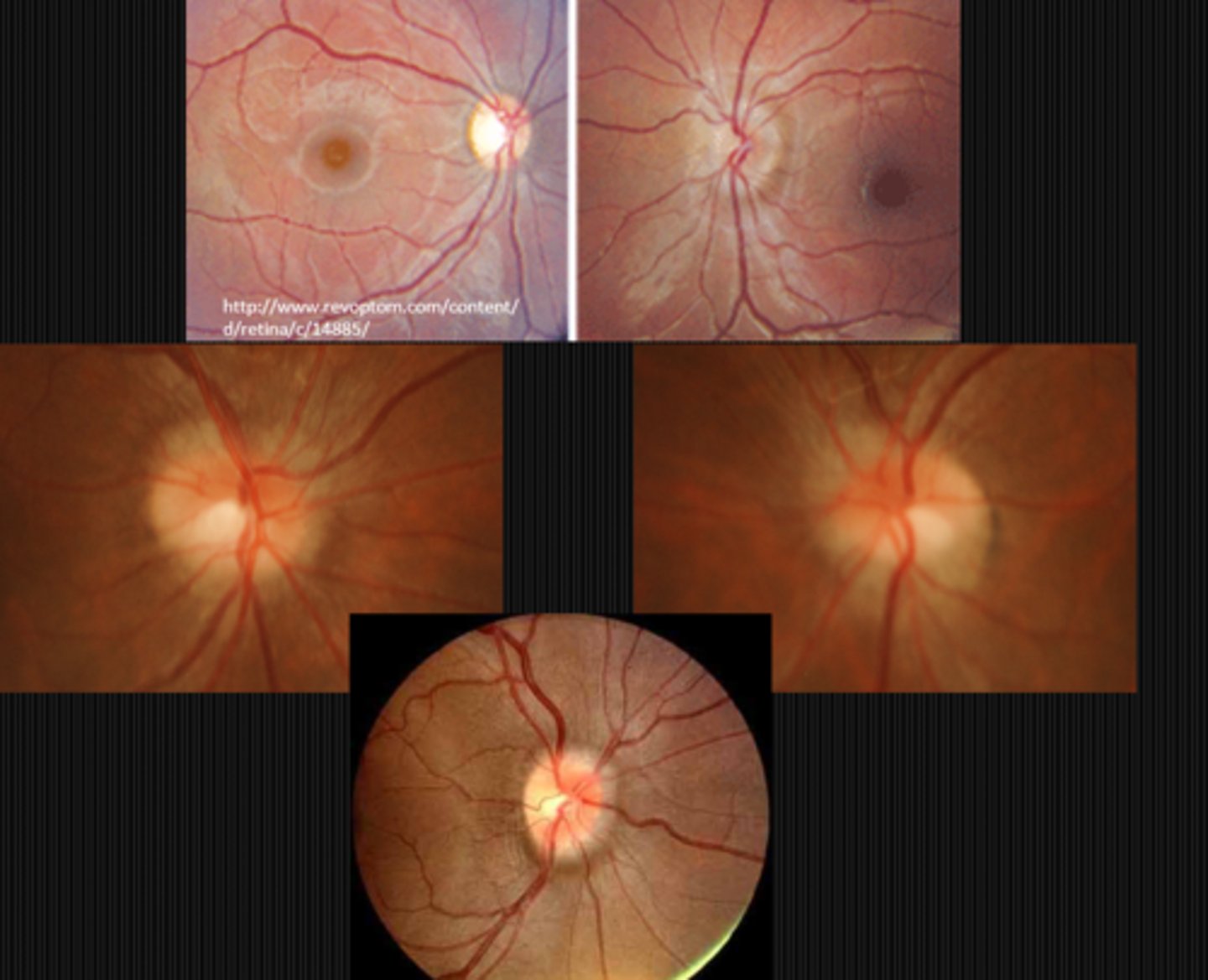 <p>papilledema = present</p><p>drusen = absent</p>