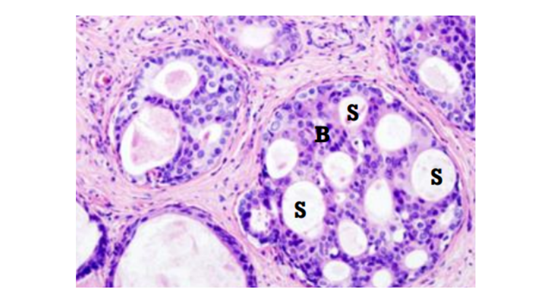 <p>Ductal Carcinoma of Breast</p>