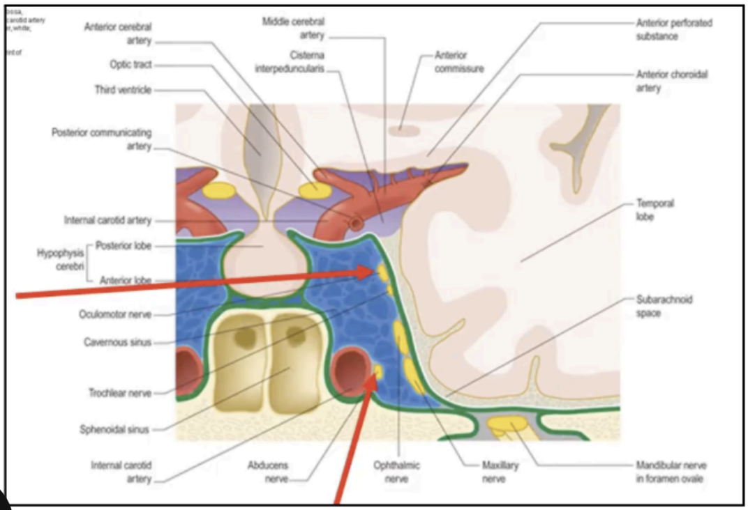 <ul><li><p>(1) From the Face via <strong>Angular and Ophthalmic Veins</strong></p></li><li><p>(2) From the Middle Ear via <strong>Petrous Sinus</strong></p></li><li><p>(3) From the Teeth, Maxillary Sinus, and Cervical Vertebra via the <strong>Pterygoid Plexus,</strong> which empties into the <strong>Inferior Ophthalmic Vein</strong></p></li><li><p>(4) From the <strong>Sphenoid Sinus</strong> as a direct extension or draining emissary vein</p></li><li><p>(5) From Infected <strong>Internal Jugular Vein, Lateral Sinus, </strong>and <strong>Petrosal Sinus</strong></p></li></ul><p></p>