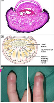 <p>abscess and infection of the fingertip pulp space</p><p>-S. Aureus is the most common organism</p><p>-most commonly occurs after penetrating skin trauma </p>