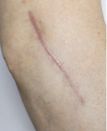 <p><strong>scar &lt;6 months that is erythematous, raised, ± pain/pruritis<br></strong>-usually evolve into mature scars by 1 year<br>-avoid sun exposure to improve healing outcomes</p>